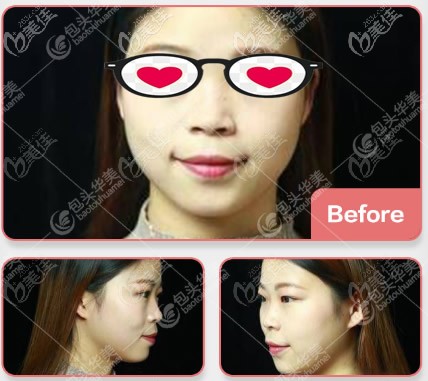 我在包頭華美做膨體半肋隆鼻前 我在包頭華美做膨體半肋隆鼻前