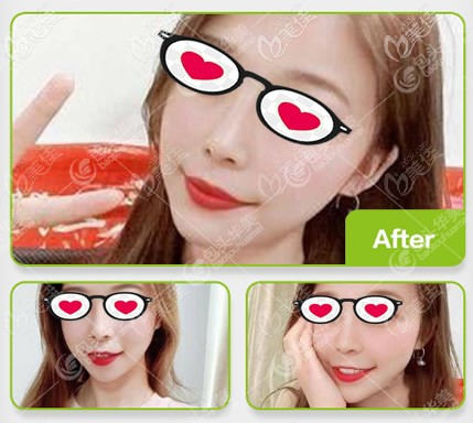 4萬元做了膨體半肋隆鼻,包頭華美王金紅醫(yī)生給做的!恢復(fù)后我覺得半肋比全肋好!