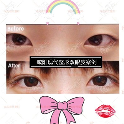 咸陽現(xiàn)代整形雙眼皮案例