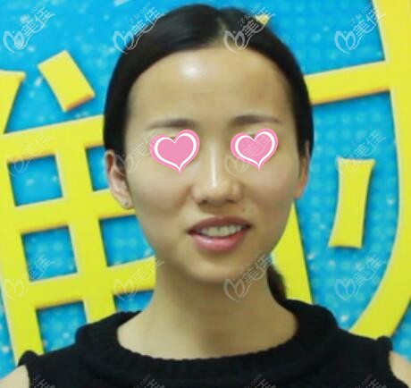 做面部脂肪填充術前照 做面部脂肪填充術前照