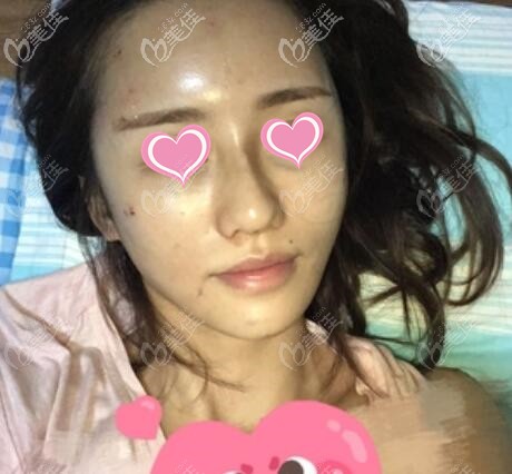 面部脂肪填充術后第2天 面部脂肪填充術后第2天