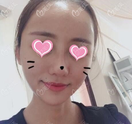 做完面部脂肪填充術后16天照 做完面部脂肪填充術后16天照