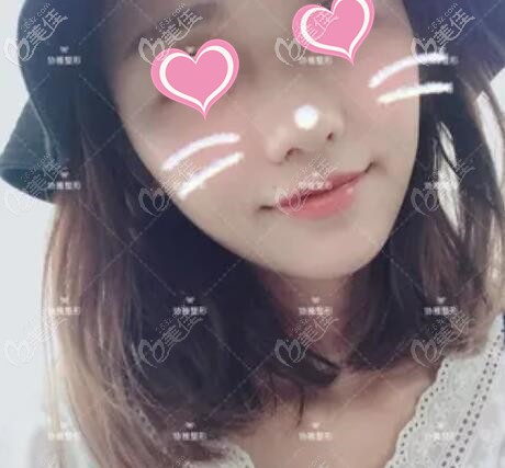 做面部脂肪填充術后1個月的恢復效果照 做面部脂肪填充術后1個月的恢復效果照