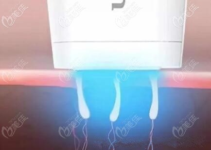 光子治療痤瘡的過程示意圖