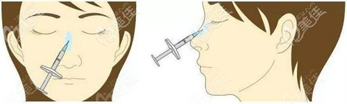 注射隆鼻的部位 注射隆鼻的部位