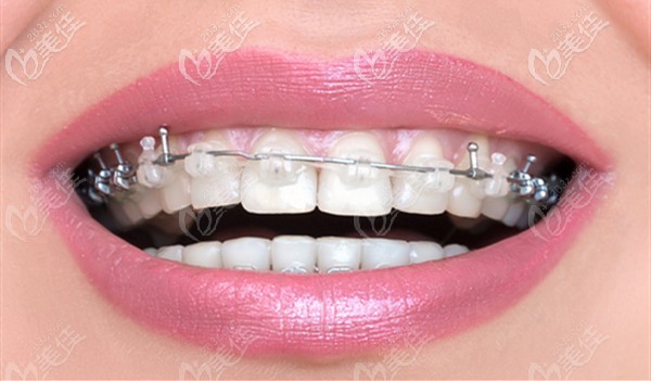 牙齒矯正的好處 牙齒矯正的好處