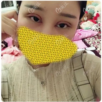 內雙做雙眼皮效果圖