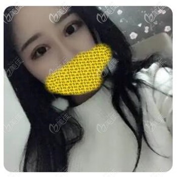 全切和埋線哪個(gè)漂亮?來份內(nèi)雙的我選擇割雙眼皮3個(gè)月后效果圖幫你做選擇