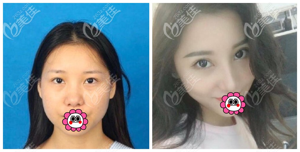 重慶軍美章小平隆鼻