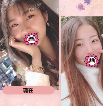 重慶華美李富強(qiáng)雙眼皮