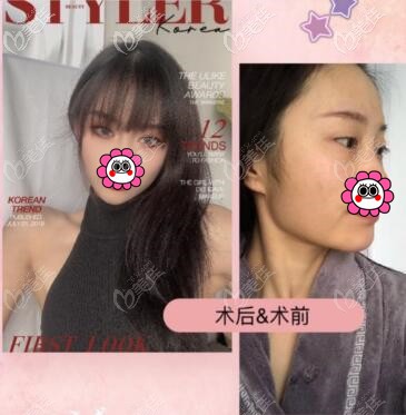 重慶華美潘寶華下頜角手術(shù)