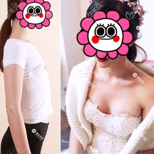 重慶華美嚴(yán)文輝隆胸