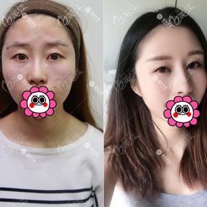 重慶華美李任隆鼻