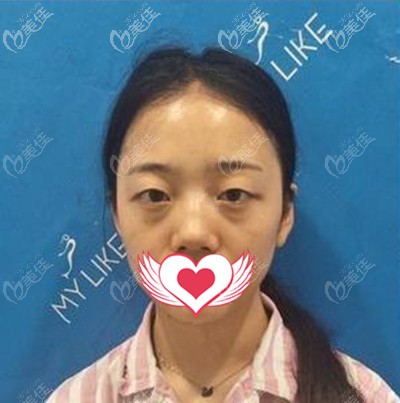 在泉州美萊華美做眼部整形手術(shù)前的我 在泉州美萊華美做眼部整形手術(shù)前的我