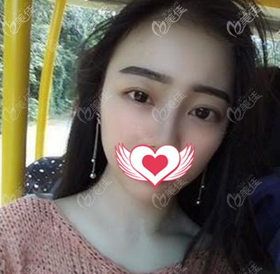 做完手術(shù)一個月照片 做完手術(shù)一個月照片