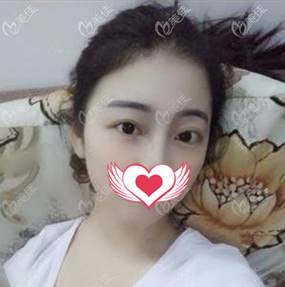 想知道在泉州美萊華美做雙眼皮+開眼角的我眼睛恢復過程嗎?快戳這...