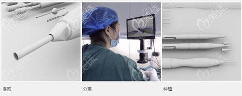 新生3D植發(fā)技術(shù)原理 新生3D植發(fā)技術(shù)原理