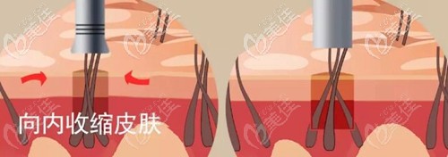 3D植發(fā)攏吸提取原理 3D植發(fā)攏吸提取原理