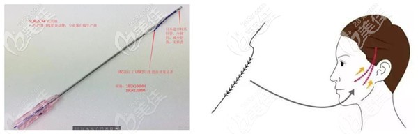 術(shù)中要是采用的大V線