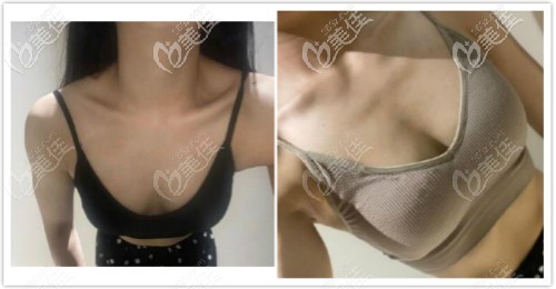 我做自體脂肪豐胸2年效果圖給大家看