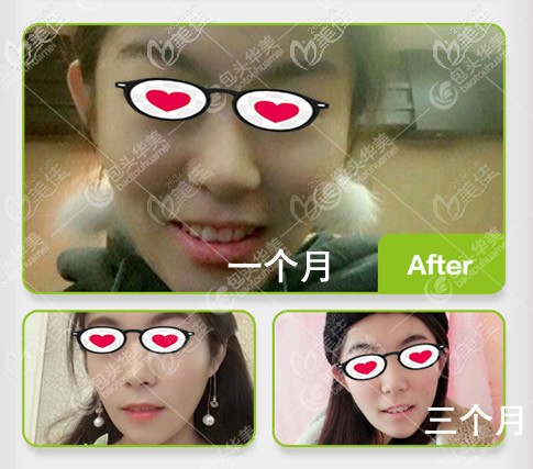 我在包頭華美臉部吸脂10天后就可以出去見人了,一個(gè)月后明顯感覺臉瘦了!