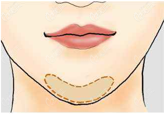 注射豐下巴