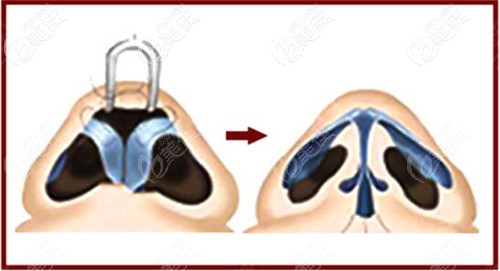 軟糖肋骨鼻M型支架