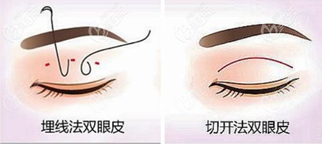 埋線雙眼皮和全切雙眼皮哪個好 埋線雙眼皮和全切雙眼皮哪個好