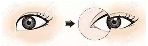 開內(nèi)眼角示意圖 開內(nèi)眼角示意圖