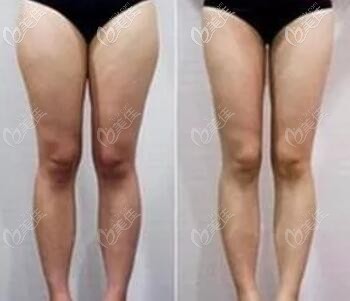 吸脂瘦大腿前后對比照