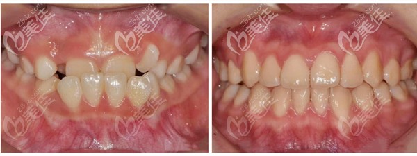 成都茁悅口腔陸開盛院長地包天案例