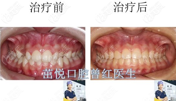 成都茁悅口腔曾紅醫(yī)生的牙列不齊矯正案例