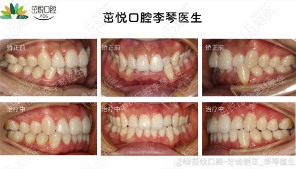 成都茁悅口腔李琴醫(yī)生的深覆合矯治案例