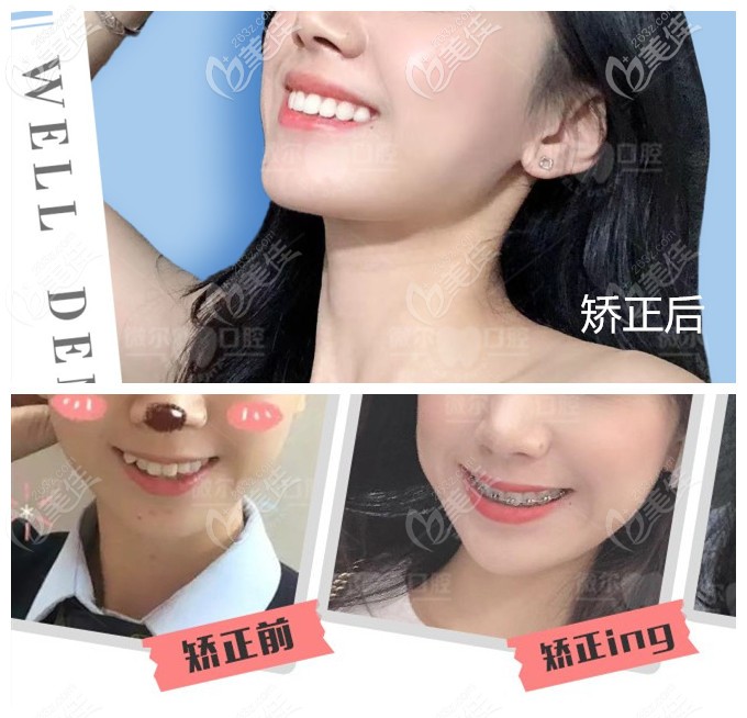 齒矯正前后對(duì)比照