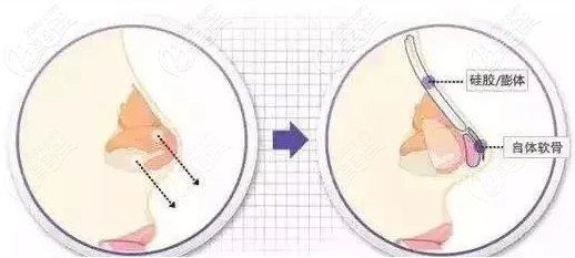 半肋骨膨體隆鼻位置