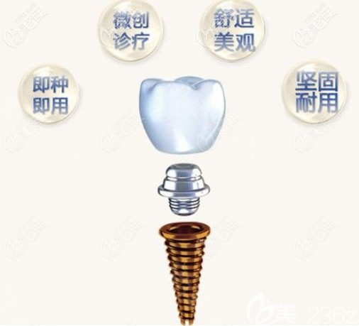 美國Hiossen種植系統(tǒng)特點