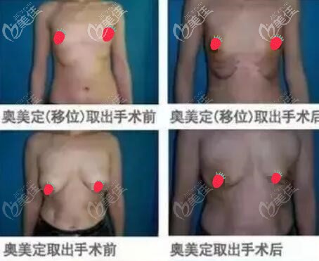 取出奧美定后的乳房形狀圖