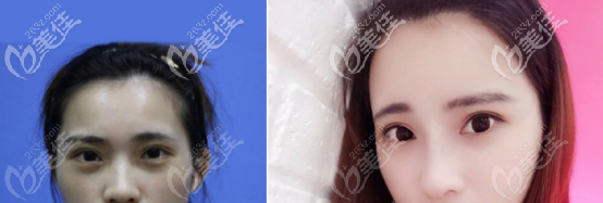 玻尿酸隆鼻案例