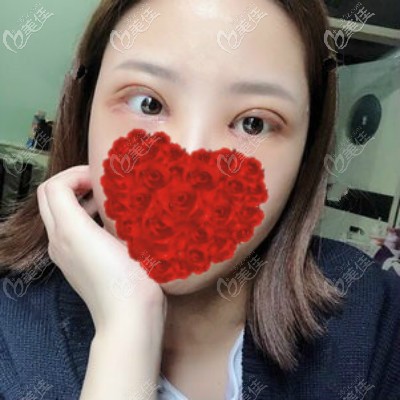 我找<!--<i data=20240703-sp></i>-->做眼綜合術(shù)后第4天效果圖