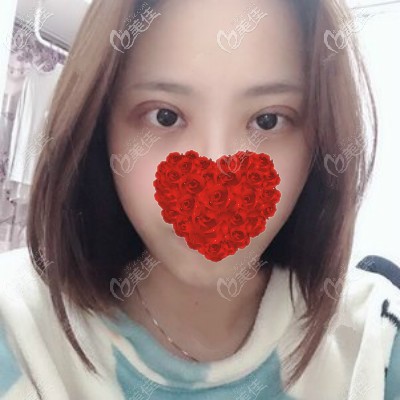 武漢五洲嚴(yán)飛雙眼皮手術(shù)案例：做雙眼皮術(shù)后第15天效果