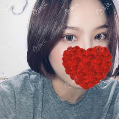 都說嚴(yán)飛醫(yī)生做眼睛技術(shù)好,找他割7mm雙眼皮果真一點(diǎn)不浮夸,自然好看