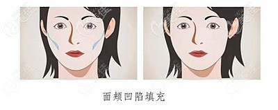 面部脂肪填充前后效果對(duì)比