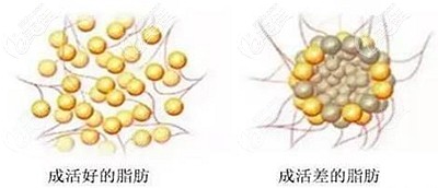 全臉脂肪填充后可能出現(xiàn)的副作用