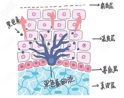 脂肪填充后臉變黑的原因