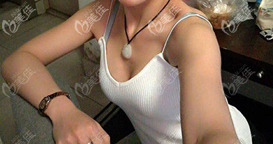 濟南藝星假體隆胸術前照片 濟南藝星假體隆胸術前照片