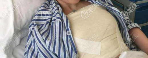 濟南藝星假體隆胸術后當天 濟南藝星假體隆胸術后當天