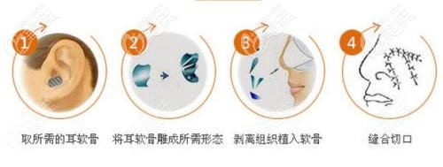 隆鼻失敗修復(fù)的耳軟骨可以二次使用