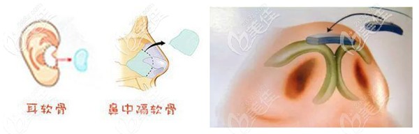 用耳軟骨和鼻中隔軟骨同時(shí)進(jìn)行修復(fù)鼻尖