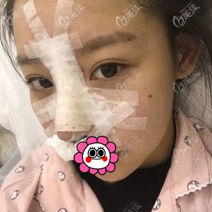 金華亞美劉政耳軟骨隆鼻術(shù)后即刻