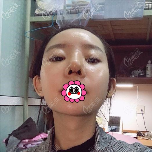 隆鼻術(shù)后到醫(yī)院拆線